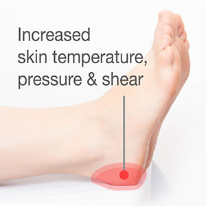 heel pressure injury