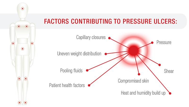 ROI-Factors-Contributing-To-Pressure-Ulcers_WEB800px Factors contributing to pressure ulcers