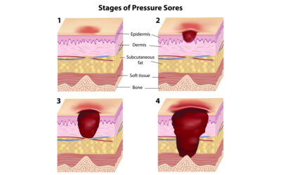 Preventing Pressure Injuries in the OR: A Quick Reference Guide
