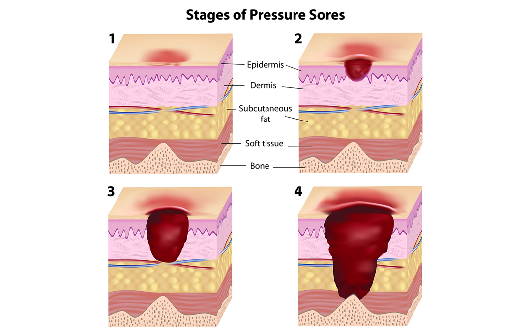 Pressure Injuries: Never Events – Part 2