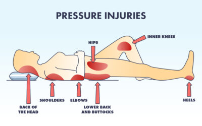 Pressure Injuries in Ambulatory Surgical Centers