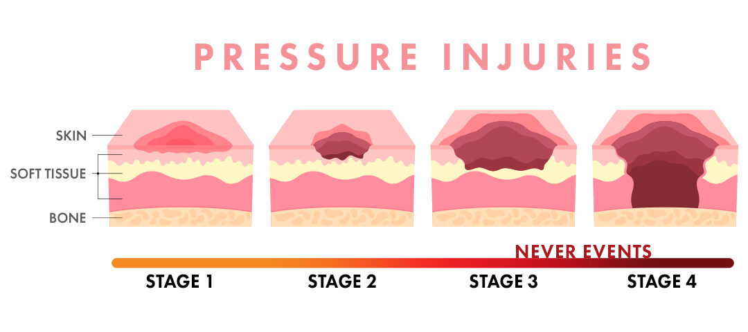 Pressure Injuries: Never Events – Part 1